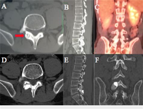 Pre Operative Computed Tomography Ct Imaging A Pre Op Axial Ct