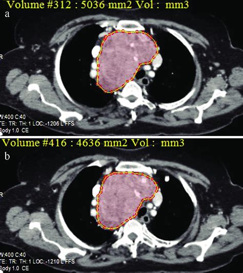 a, b. Estimation of the volume of the mediastinal thyroid mass by ...