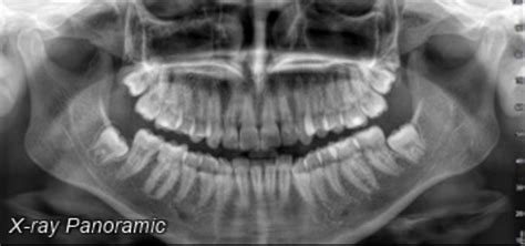 Is The Arch In My Opg Normal The Majority Of The Examples Ive Seen