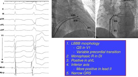 How To Map And Ablate Parahisian Ventricular Arrhythmias Heart Rhythm