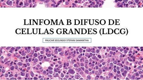 Res Menes De Linfoma B Descarga Apuntes De Linfoma B