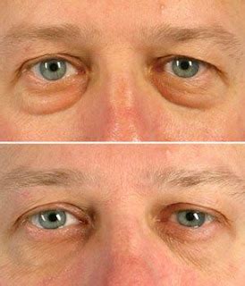 Facial Aerobics Exercises For Men And Women Permanently Minimize Eye