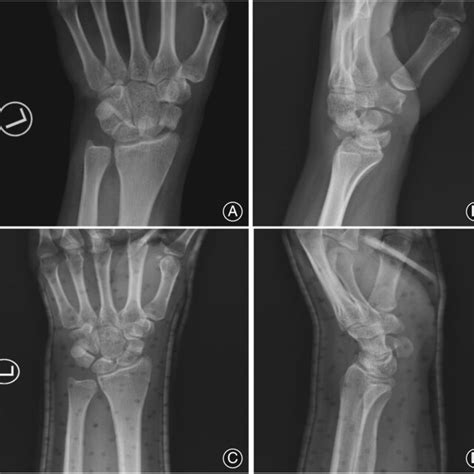 Preoperative Radiographs A B Posteroanterior Pa And Lateral Films