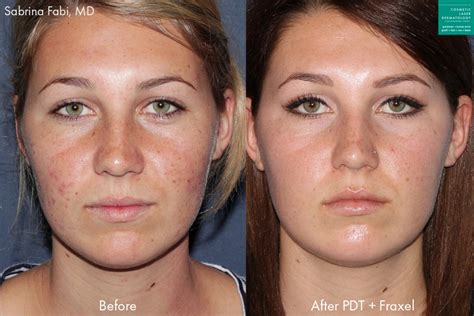 Photodynamic Therapy Acne Treatment | San Diego, CA | CLDerm