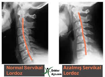 Lomber ve Servikal Lordoz Azalaması Düzleşmesi