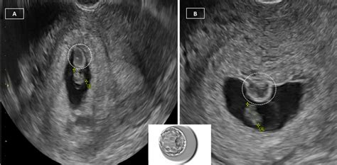 Chorionic Bump In Early Pregnancy Associated With First Trimester Miscarriage Bmj Case Reports