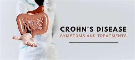 Crohns Disease Symptoms Causes Complications Prevention 50 Off