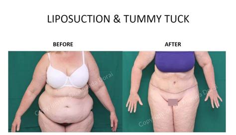 Does Insurance Cover Tummy Tuck After Weight Loss Weight Loss Wall