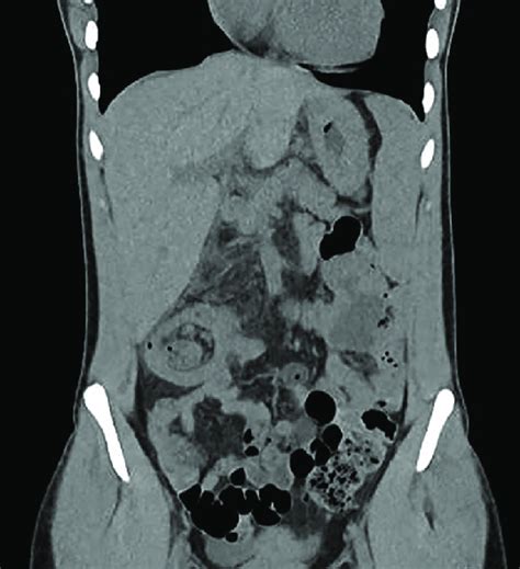 Computed Tomography Abdomen And Pelvis Coronal Section Showing Target