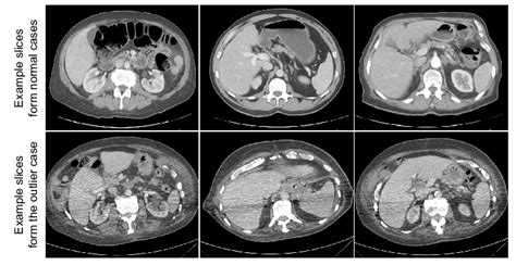 Illustration Of Example Ct Slices From General Cases And An Outlier Download Scientific Diagram