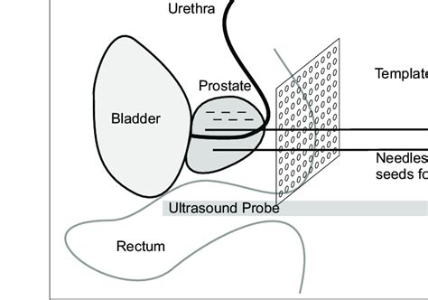 Brachytherapy Ati Template