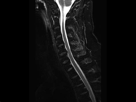 Comprehensive Cervical Spine Imaging At 3 0t Philips Mr Body Map