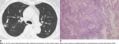 Figure 3 From Ct Findings Of Atypical Adenomatous Hyperplasia In The Lung Semantic Scholar