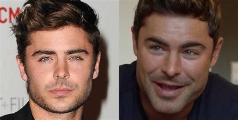 ¿qué Se Hizo Zac Efron En El Rostro Cirujano Plástico Lo Explica