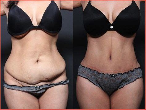 Las Mejores Ideas De Abdominoplastia Antes Y Despues