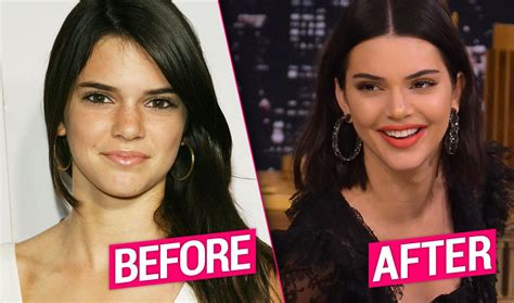 Kendall Jenner S Plastic Surgery Exposed By Top Docs