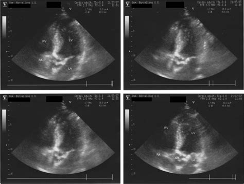 Asymptomatic Double Site Of Left Ventricular Outflow Tract Obstruction