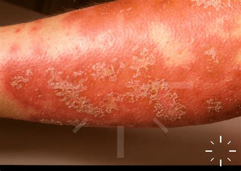 Generalised Pustular Psoriasis