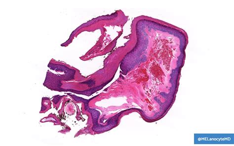 75f W Pruritic Vulvar Lesion Kiko Xp