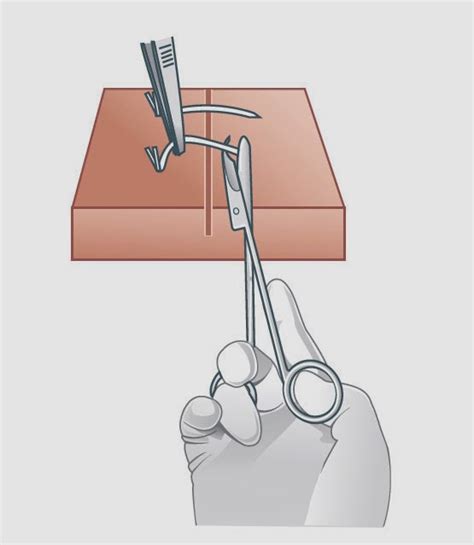 Removing Sutures and Staples ~ Nursing