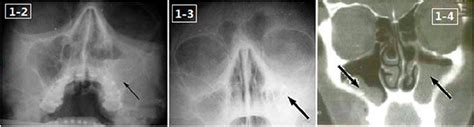 Sinusitis Concise Medical Knowledge