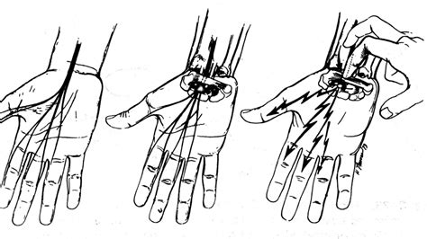 SÍndrome Del TÚnel Carpiano ¿qué Es Anatomía Causas Y Más