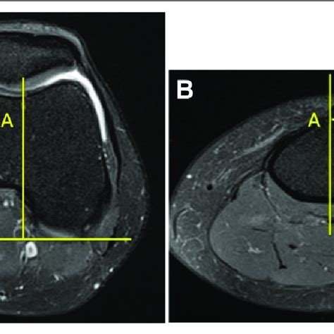 Measurement Of Tibial Tubercle Trochlear Groove Tt Tg Distance The