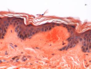 Patologia Primaria Dell Amiloidosi Cutanea Dermatly Il Sito