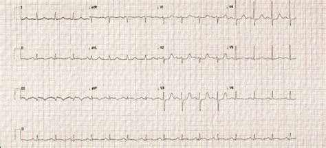 Electrocardiogram Demonstrating Sinus Rhythm With Q Waves In Lead Iii