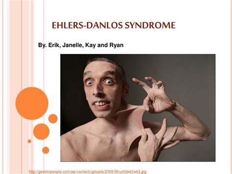 PPT - EHLERS-DANLOS SYNDROME PowerPoint Presentation - ID:266473