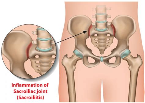 Chiropractic Treatment Of Sacroiliac Joint Pain Back Care Clinic