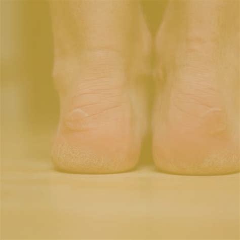 Fat Pads Atrophy Syndrome Well Heeled Podiatry In Hampton