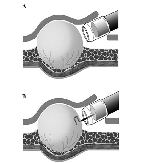 Evaluation Of Gastric Submucosal Tumors Using Endoscopically Visualized