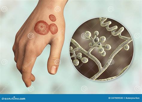 Hand Fungal Infection Tinea Manuum 3d Illustration Royalty Free