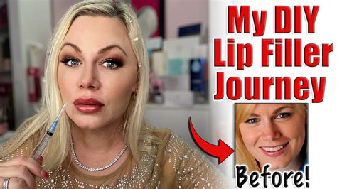 Lip Filler Tips And Tricks