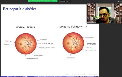 Implementan Sistema De Diagn Stico Temprano De Retinopat A Diab Tica