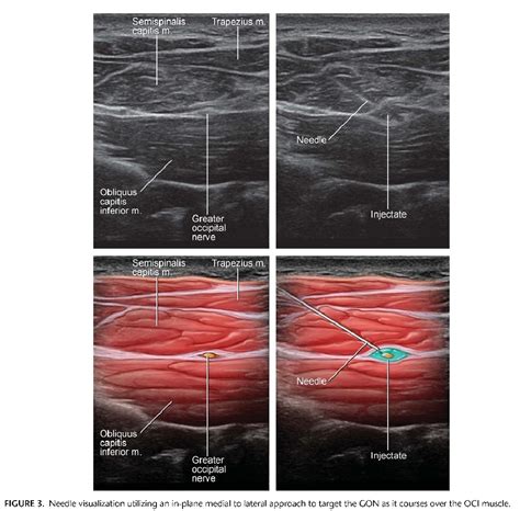 Ultrasound Guided Occipital Nerve Block