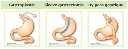 Indications Et Contre Indications De La Chirurgie Bariatrique IPCO Alsace