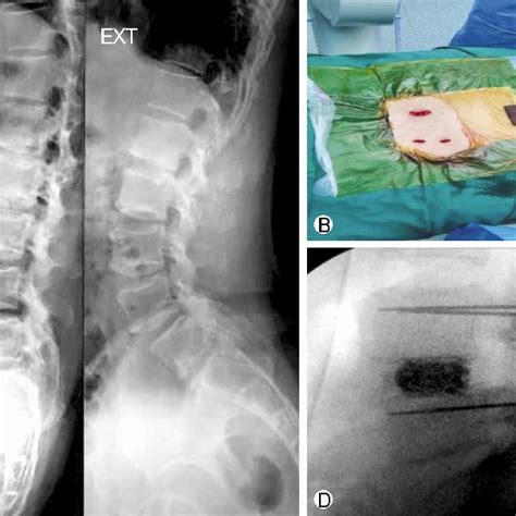 Minimally Invasive Transforaminal Lumbar Interbody Fusion Download Scientific Diagram