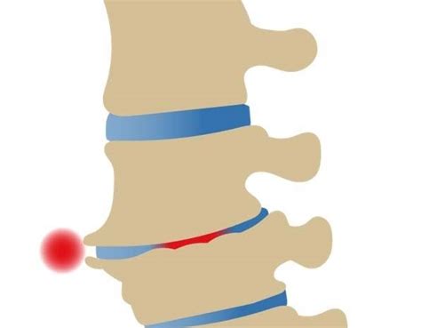 Soulager L Arthrose Lombaire Ou Lombarthrose Arthrose Rachis