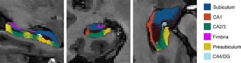 An Illustration Of Hippocampal Subfield Segmentation Using An Automated