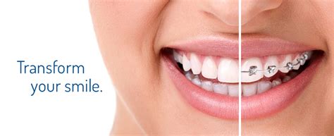 Orthodontics Dentist Ryde Gladesville North Ryde Eastwood