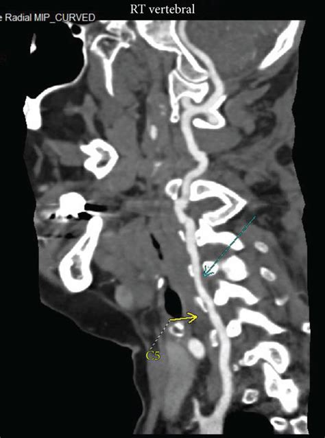 A Computed Tomography Angiography Imaging Showing The Right Vertebral