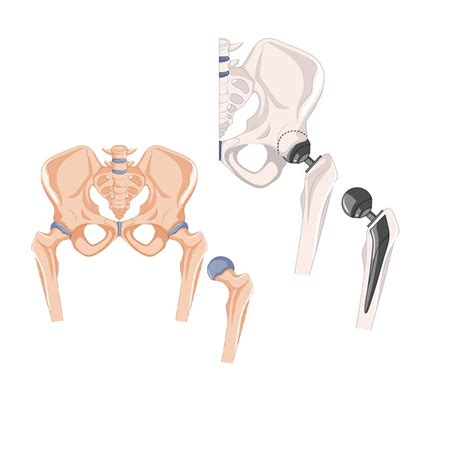Joint Reconstruction - Ortho and Gynae Health