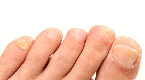 Toenail Fungus Signs Causes And Cure