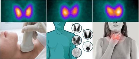 Yodo Radiactivo Qué es Cómo funciona Historia Usos Procedimiento