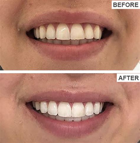 Teeth Whitening Before And After Pictures Gorgeous Smiles