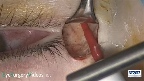 Lateral Canthal Tendon Re Position And Soof Lift Oculoplastic