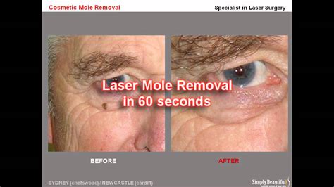 Laser Mole Removal Youtube