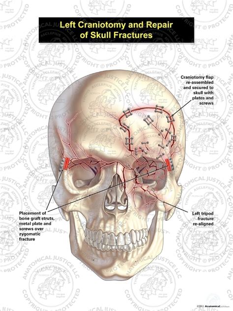 types  skull fractures diagram